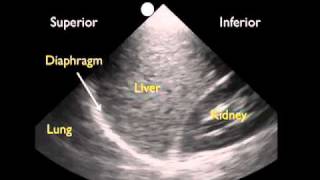 How To Ultrasound Detection of Pleural Fluid Case Study Video [upl. by Uriiah857]