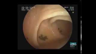 Endoscopic Imaging of a Flat IIaLSTG Homogeneous Type Colonic Polyp [upl. by Ecirted]