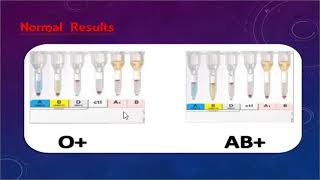 ABO discrepancy and transfusion practice part one By Dr Mohamed Samir [upl. by Darryn280]