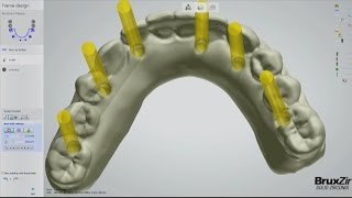 Fabrication of the BruxZir® FullArch Implant Prosthesis Vol 1 Issue 2 [upl. by Faulkner]