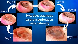 How does traumatic eardrum perforation heals [upl. by Naujek764]