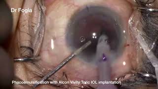 Alcon Vivity Toric IOL implantation [upl. by Ahsiram]