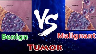 Benign Tumor Vs Malignant Tumor  Clear Comparison [upl. by Assenyl533]