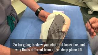 Deep Plane Facelift Demonstration amp Explanation Nongraphic [upl. by Euginimod]