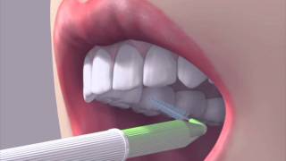 How to use an interdental brush [upl. by Sumahs945]