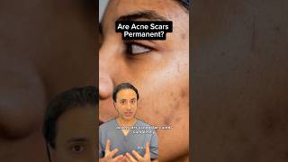 Are Acne Scars Permanent Dr Solomon explains how to treat them  Dr Medispa [upl. by Halstead]