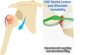 Shoulder Dislocation And Hill Sachs Lesion [upl. by Basia546]