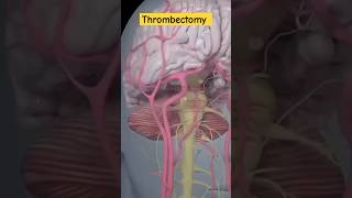 mechanical thrombectomy strokeanatomymedicalcareofHow [upl. by Colpin]