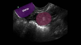 POCUS 1st Trimester Pregnancy Case 4  Ectopic Pregnancy [upl. by Silyhp]