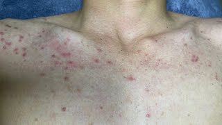 ACNE TREATMENT VU QUYNH MI Blackheads On Boy Chest 2024 [upl. by Jair497]