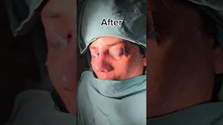 Revision Rhinoplasty [upl. by Hanad]