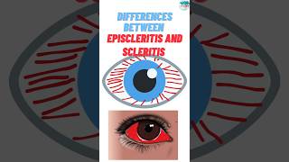 What are the Differences Between Episcleritis and Scleritis rheumatoidarthritisautoimmunediseases [upl. by White]