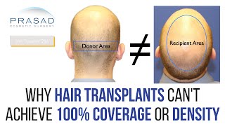 Why Hair Transplants Cannot Achieve 100 Coverage or Density and Getting Density NonSurgically [upl. by Cyrie564]