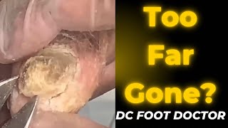 Too Far Gone Severe Fungal Toenails [upl. by Levy]