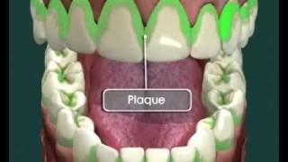 Tooth Decay  How it Happens and How to Avoid it [upl. by Jenilee]