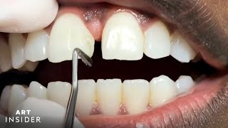 How Tooth Gaps Are Filled  Insider Art [upl. by Ylellan628]