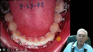 Orthodontics of the Future Impacted Teeth Case 2 [upl. by Ronnholm834]