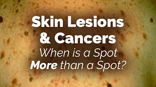 When is a Spot More than a Spot Skin Lesions and Cancers [upl. by Ranson985]