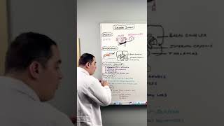 Ischemic Stroke  Lacunar Infarct shorts [upl. by Nya]