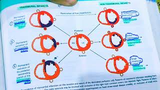 Myocardial Infarction pathologyAnterior wall MISTEMI AND NSTEMIHeart pathologyRobbins pathology [upl. by Nilekcaj812]