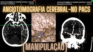 MANIPULAÇÃO ANGIOTOMOGRAFIA CEREBRAL NO PACS DA NOVAEAD [upl. by Ligriv]