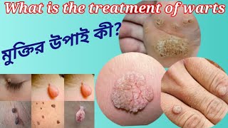 different types of warts and how to treat them warts varuca vulgaris mosaic minoxidil [upl. by Janelle]