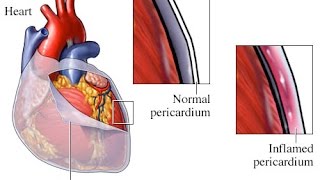 Pericarditis [upl. by Gurias]