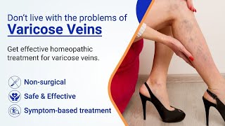 Vericose Veins Treatment  Scelero Therapy vericose veins yt treanding viralvideo [upl. by Zeralda925]