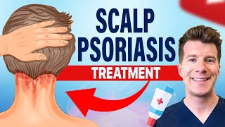 Doctor explains FOUR TREATMENTS for SCALP PSORIASIS [upl. by Adlesirk]