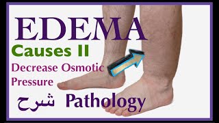 Pathology  Edema causes Decrease Osmotic Pressure  👨🏻‍⚕️ شرح باثو [upl. by Neurath]