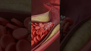 हार्ट के ब्लॉकेज का आसान इलाज Short Animated Video Shows Angioplasty Procedure in Action in 2024 [upl. by Bertle]