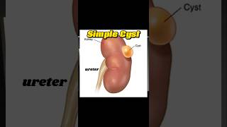 Renal Cyst  Simple Kidney Cyst  Cyst  Fluid Filled  Kidney Ultrasound [upl. by Caia210]