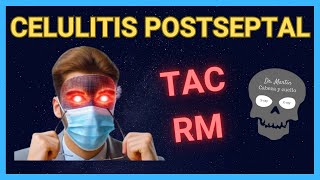 CELULITIS POSTSEPTAL Signos Radiológicos 👀 [upl. by Iives]