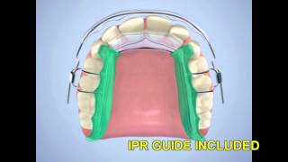 Minor Tooth Movement Appliance  Inman Aligner  Anterior Relapse Correction [upl. by Birdt700]