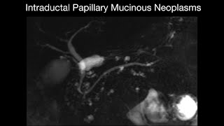 Intraductal Papillary Mucinous Neoplasms [upl. by Yenot741]