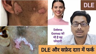 Discoid Lupus Erythematous  DLE और सफ़ेद दाग़ Vitiligo में फर्क  Selena Gomez को है यह परेशानी dle [upl. by Emanuel]