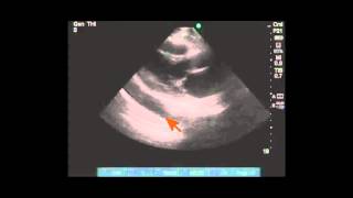 Differentiating pleural vs pericardial effusion by anatomy on echo [upl. by Nenney390]