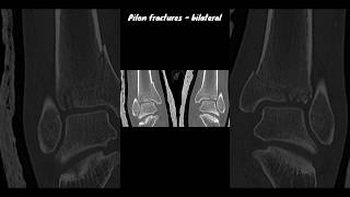 Pilon fractures  bilateral ctankle [upl. by Idalla605]