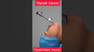 THYROID CANCER  THYROID REMOVAL 3D ANIMATION biologyislife howtogetsuccessinlife getsuccess [upl. by Elane201]