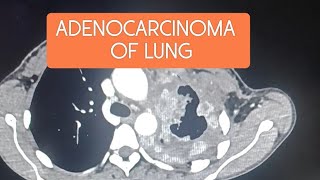 Adenocarcinoma of lung cect ctscan lungs pulmonary radiology hrct cancer carcinoma tumor [upl. by Yanffit]