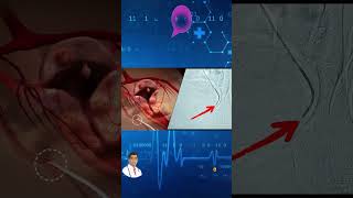 Uterine Fibroid Embolization Live Surgery [upl. by Mialliw]