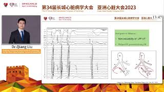 Left Posterior Fascicular VT and False Tendon at GWICCAHS 2023 [upl. by Akerley]