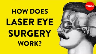 How does laser eye surgery work  Dan Reinstein [upl. by Shieh]