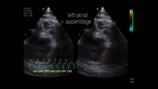 Paroxysmal supraventricular tachycardia  Tachycardie paroxystique supraventriculaire [upl. by Eirffej]