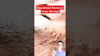 TERRIBLE BLACKHEAD REMOVAL  Shocked At This One shorts [upl. by Gamaliel920]