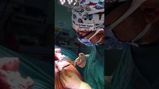 Closing up a “T” Tummy Tuck shorts plasticsurgery plasticsurgeon stitching turkey istanbul [upl. by Auohp]