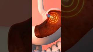 Endoscopy VideoEndoscopy procedure की एंडोस्कोपीتنظير المعدةviralshortsdrsadia1446 [upl. by Isac]