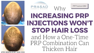 Why Increasing PRP Injections Wont Stop Hair Loss and OneTime Treatment to Thicken Hair [upl. by Couhp608]