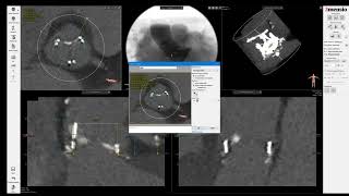 3Mensio CT precase planning ValveinValve TAVR in PerimountMagna Surgical Aortic Valve SAV [upl. by Yraunaj877]