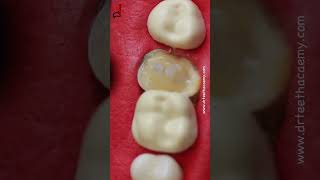 Deep cavity restoration toothcaries toothcavity [upl. by Fransis]